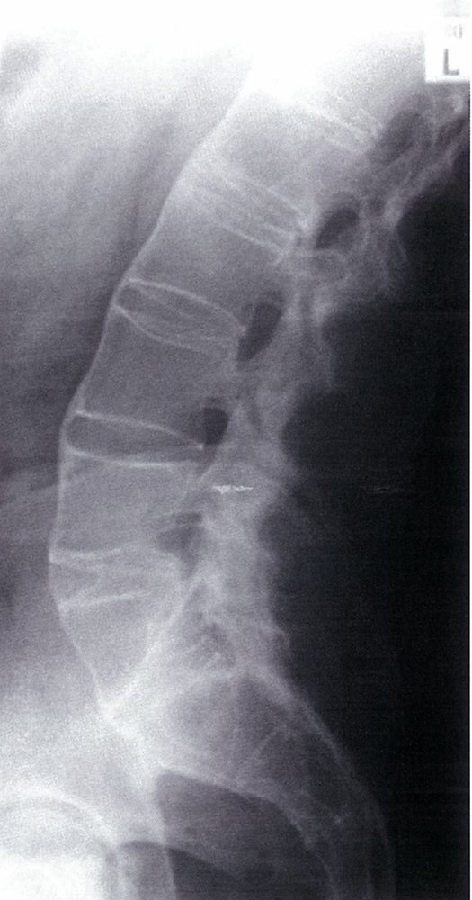 Lumbar ankylosing spondylitis