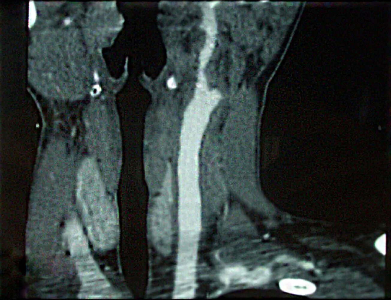 External carotid artery stenosis