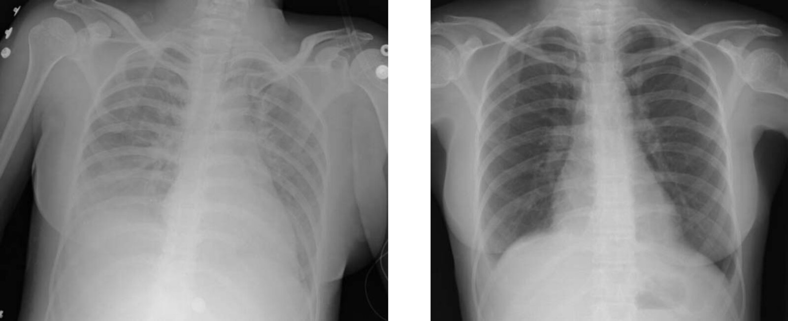 Acute lung injury after transfusion
