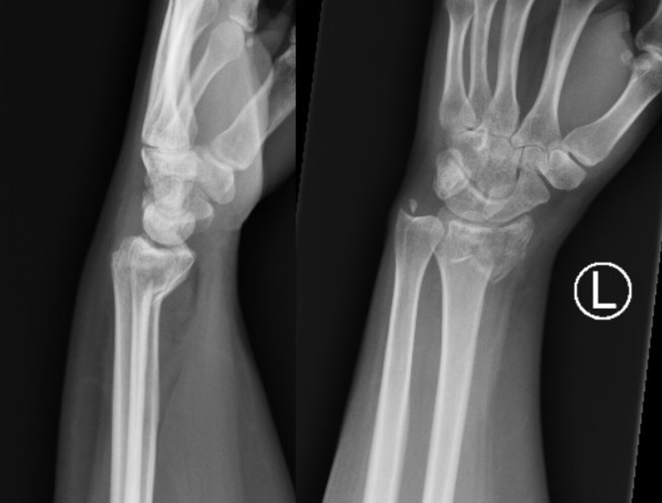 Comminuted distal radius fracture with intraarticular extension