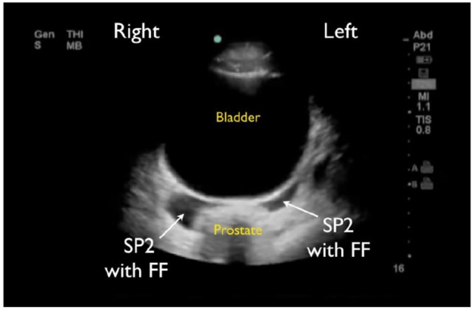 FAST exam of the male pelvis with free fluid