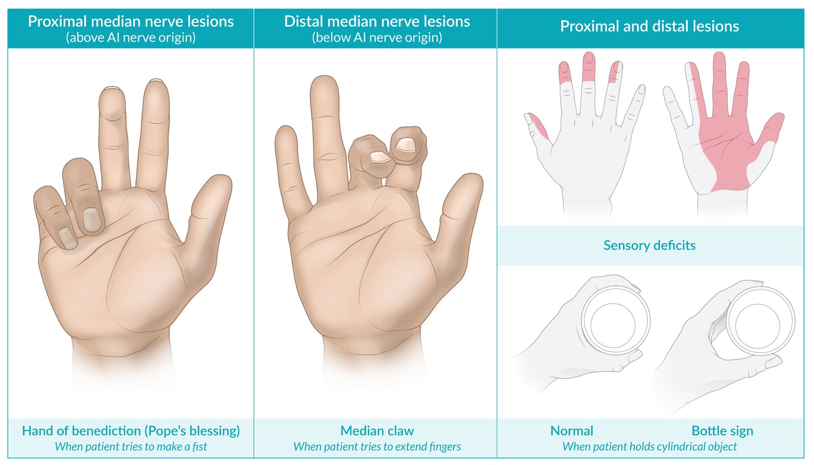 Proximal and distal median nerve lesions