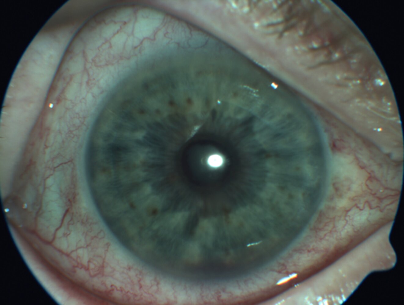 Anterior uveitis