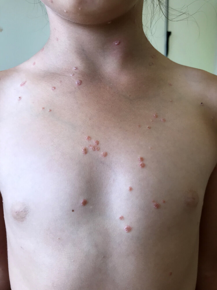 Guttate psoriasis
