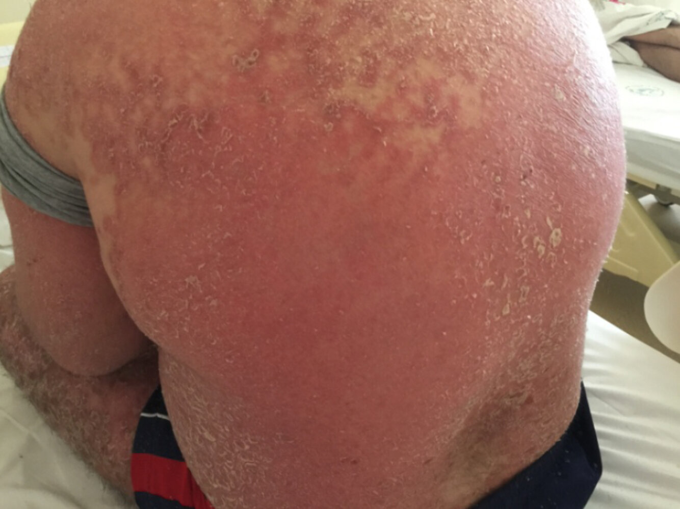 Erythrodermic psoriasis