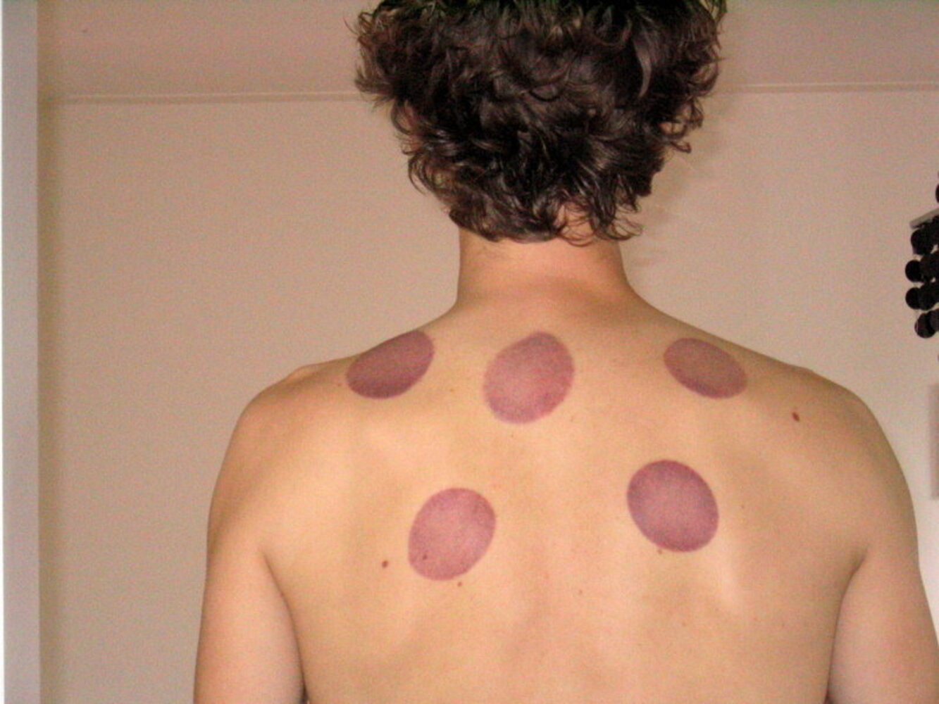 Cupping marks