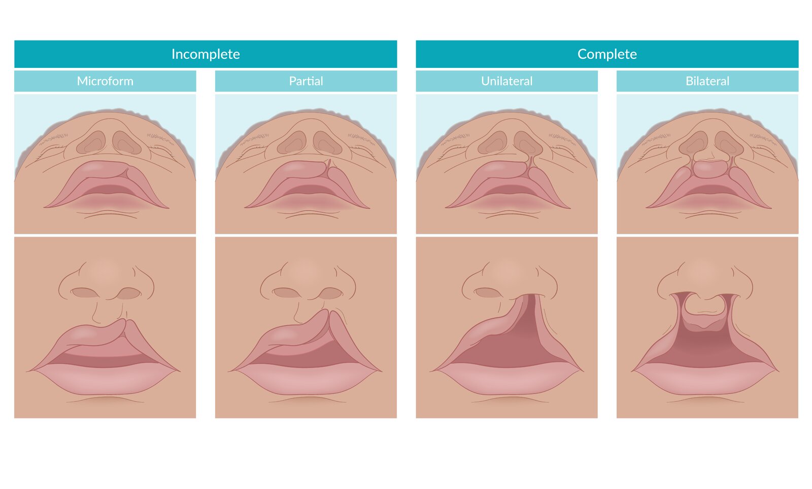 Incomplete vs. complete cleft lip