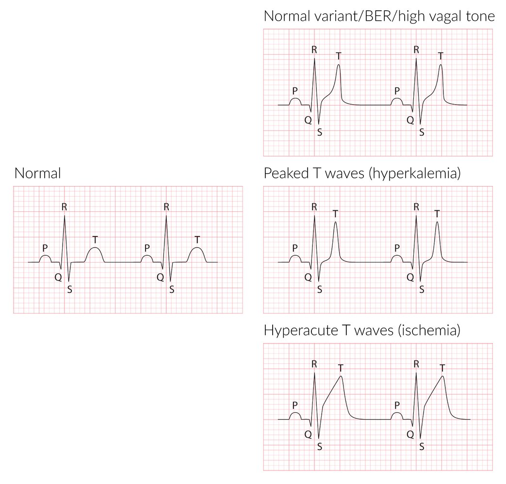 Abnormalities of the T-wave