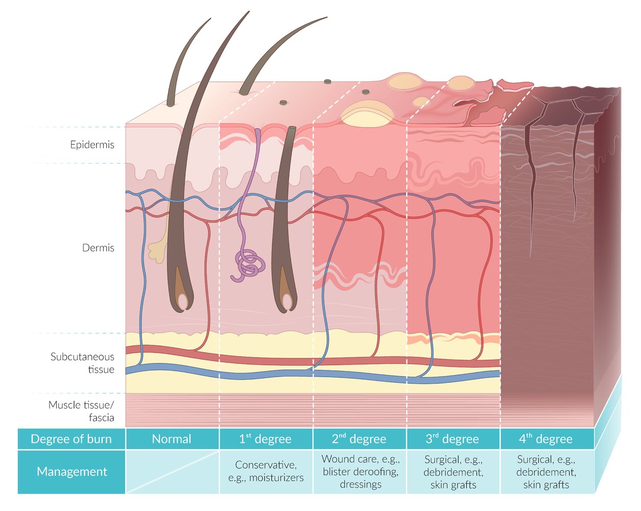 Burn classification