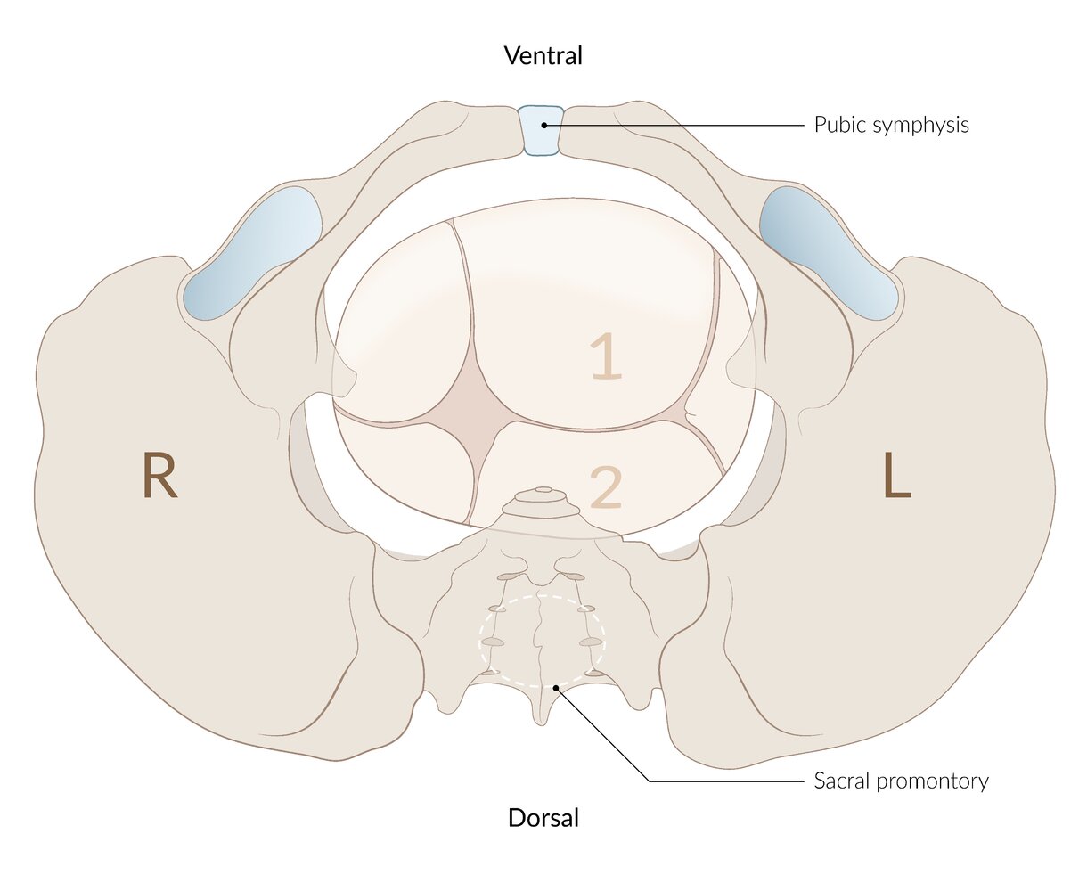Anterior asynclitism (Naegele obliquity)