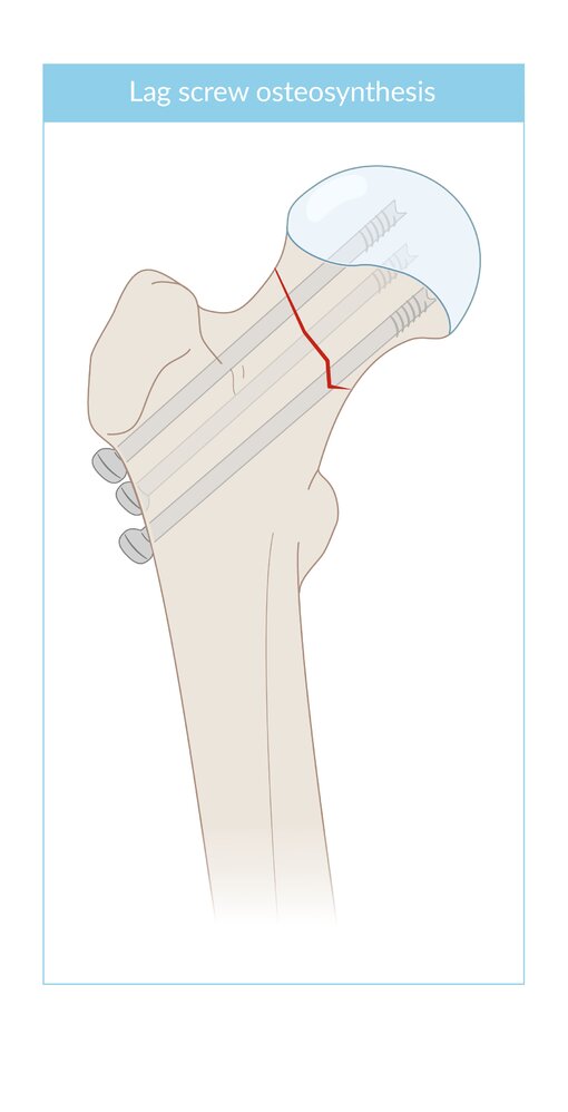Cancellous lag screw osteosynthesis of femoral neck fracture
