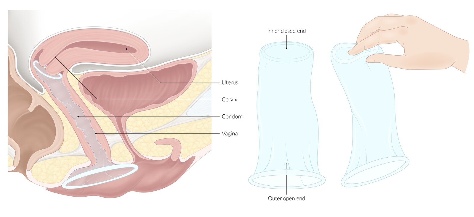 Female condom (internal condom)