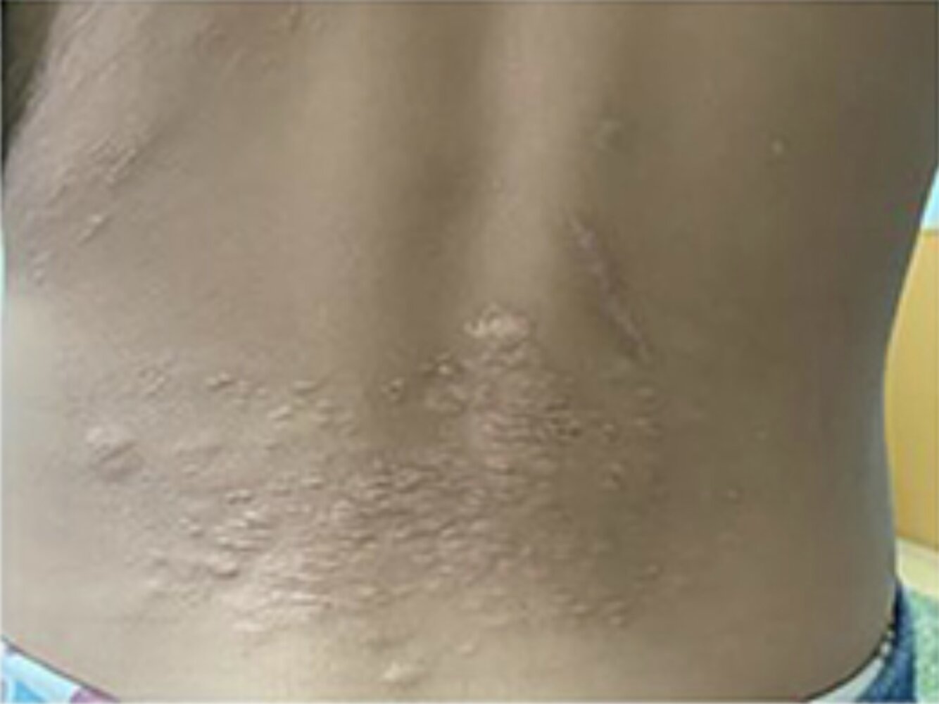 Shagreen patch