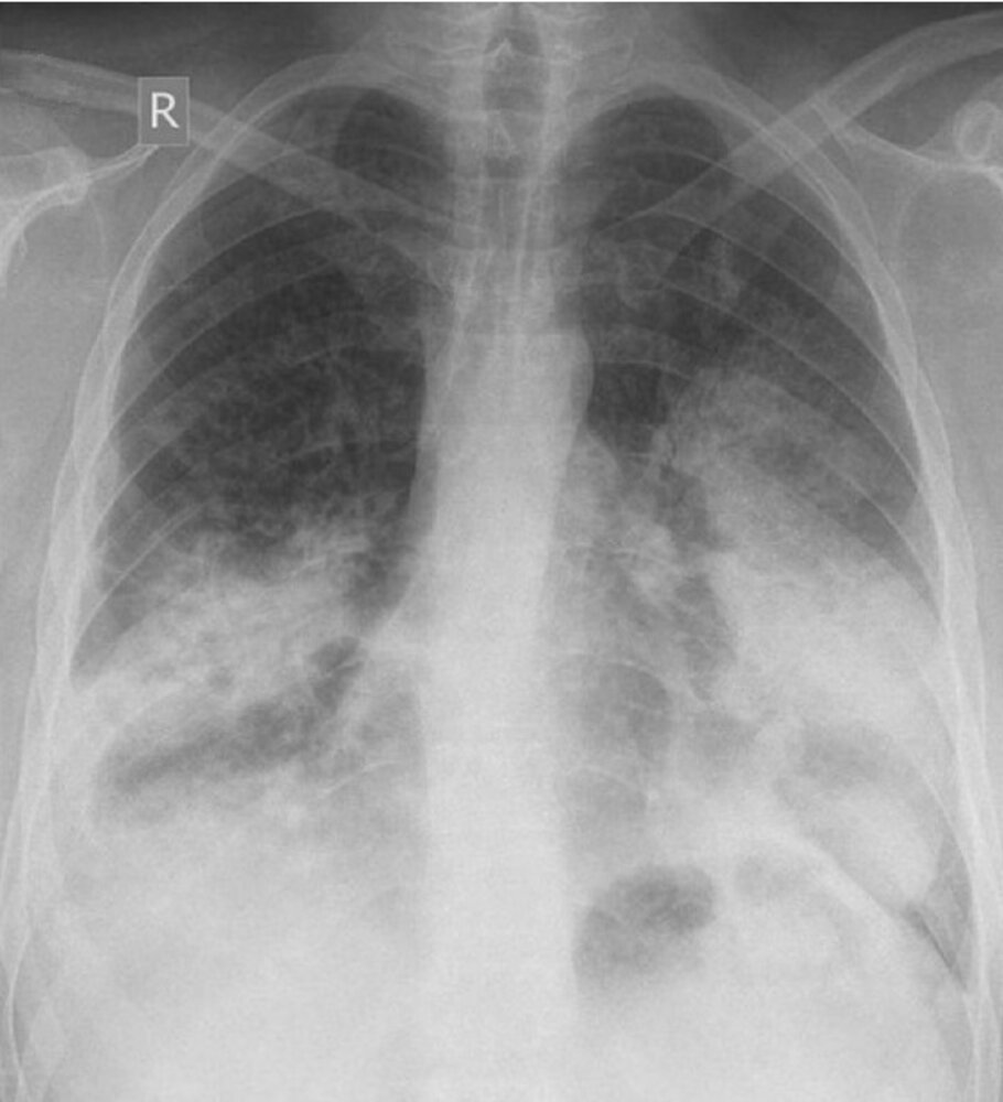 Invasive mucinous-predominant adenocarcinoma simulating pneumonia
