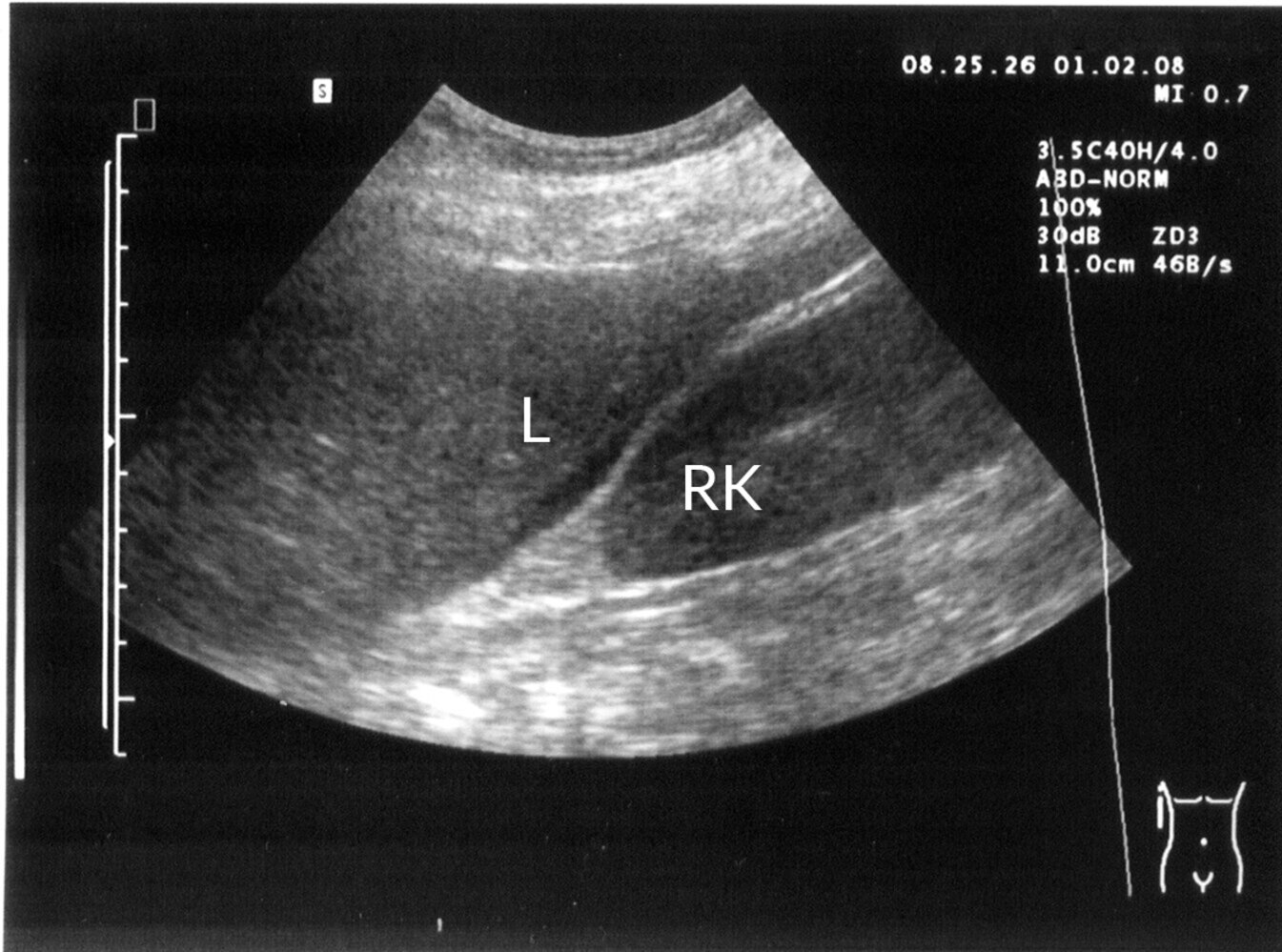 Intraperitoneal free fluid in the hepatorenal space