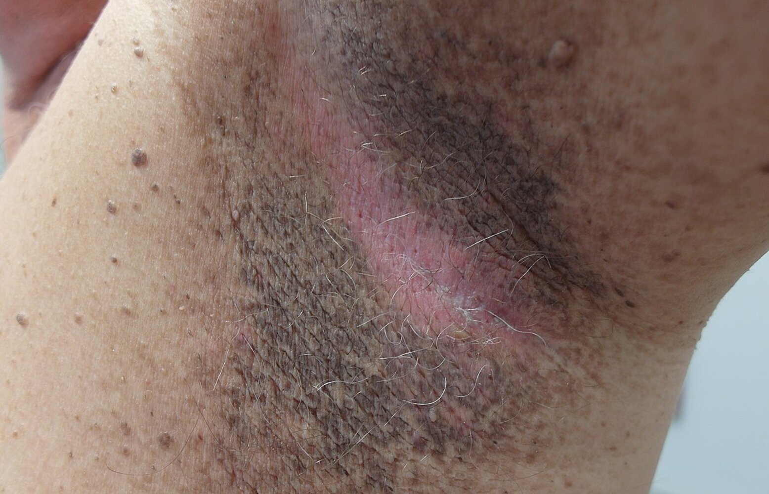 Acanthosis nigricans