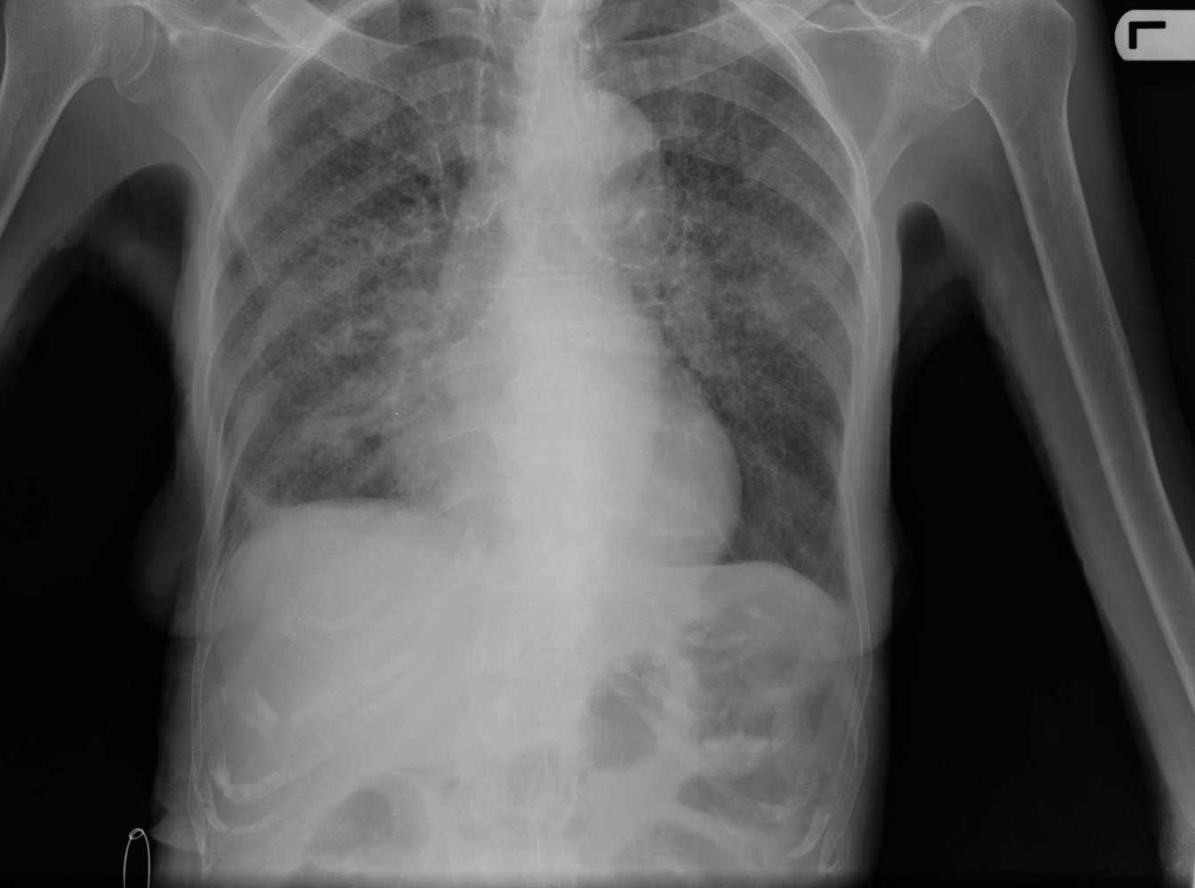 Miliary lung nodules