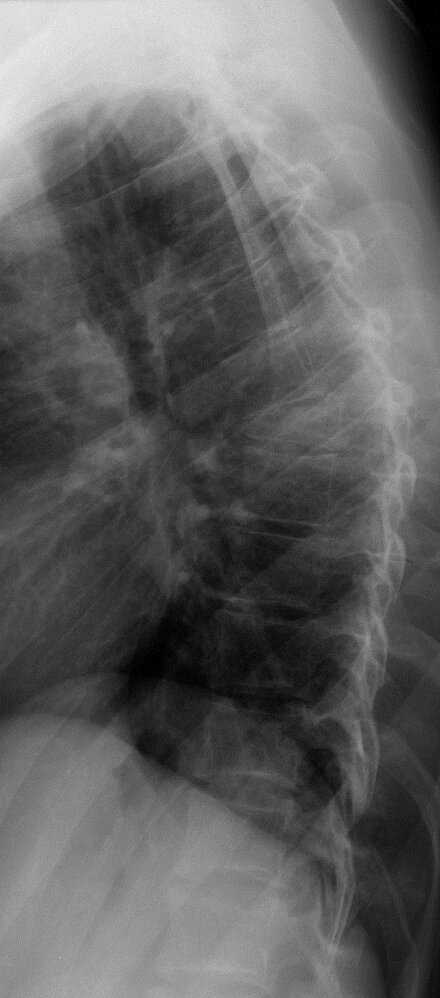 Thoracic wedge compression fracture