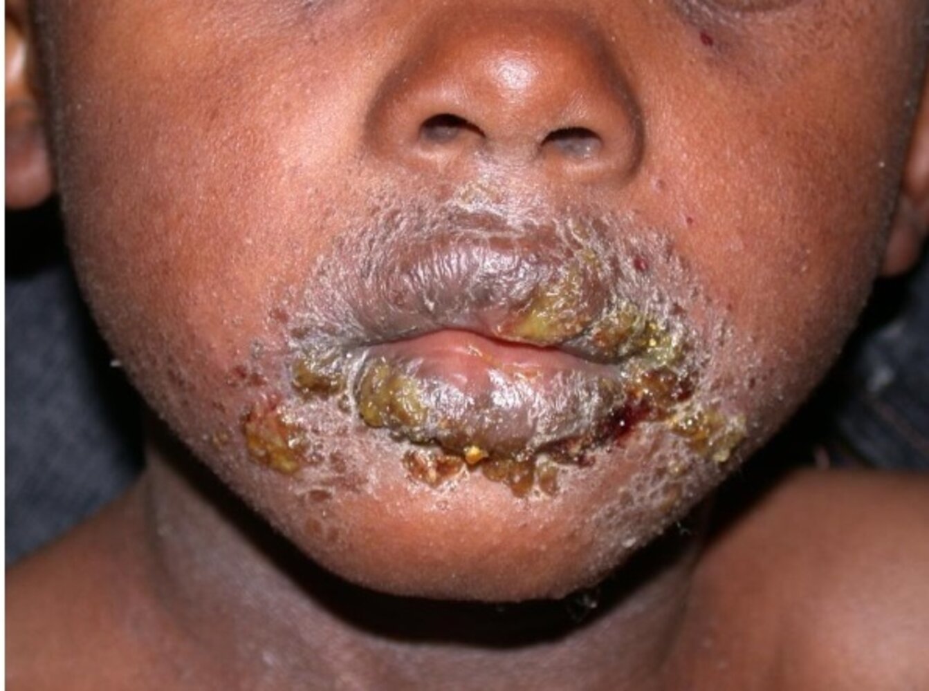 Impetigo