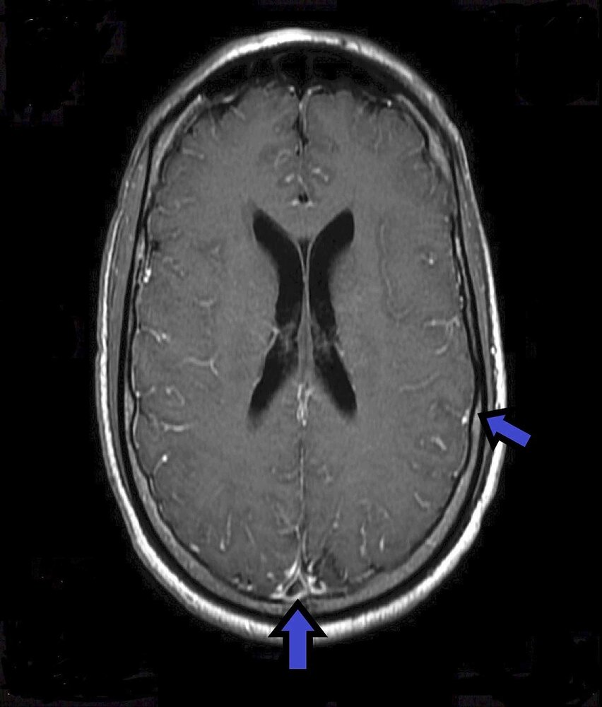Cryptococcal meningitis