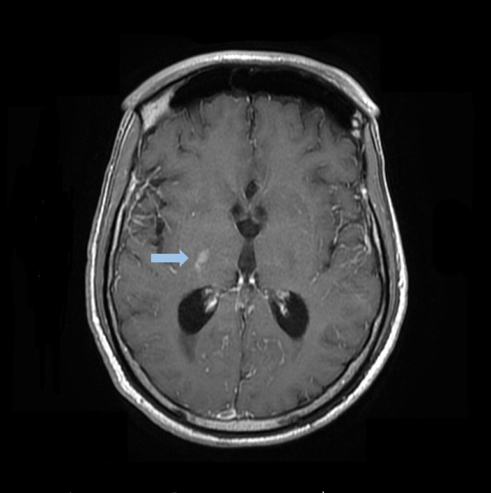 Cryptococcosis