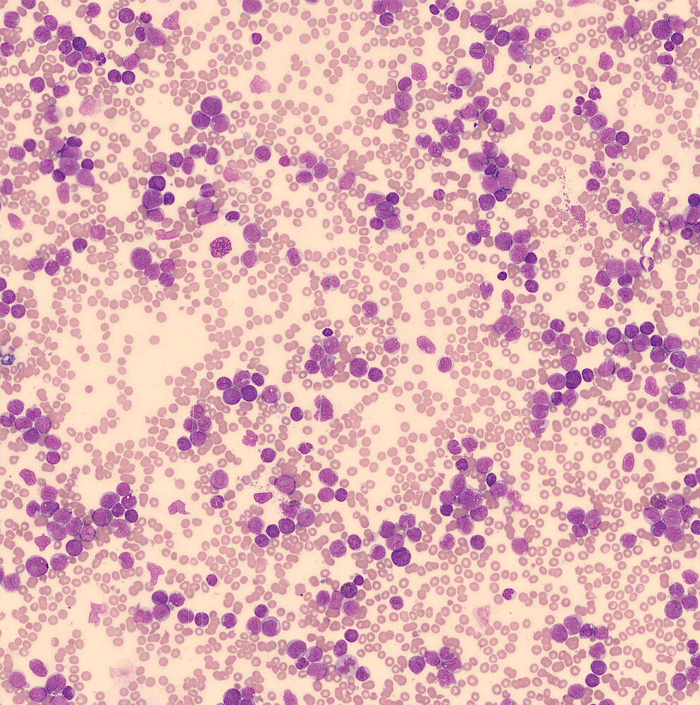 Hyperleukocytosis in acute myeloid leukemia (AML)