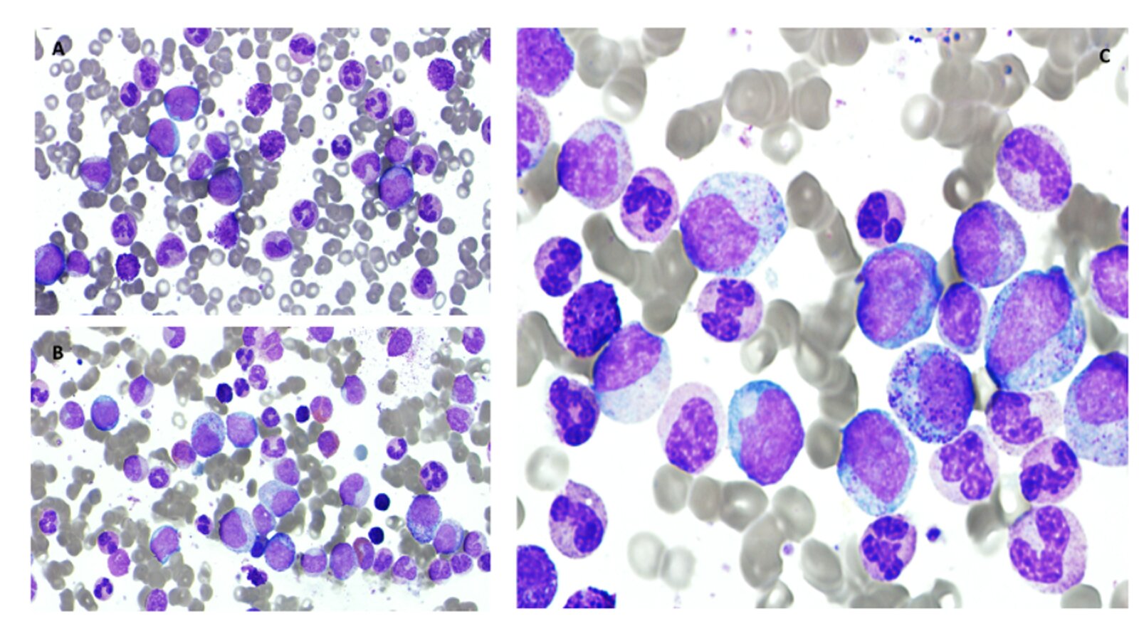 Hyperleukocytosis in chronic myeloid leukemia