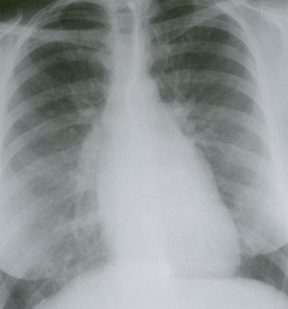Enlarged left atrial appendage