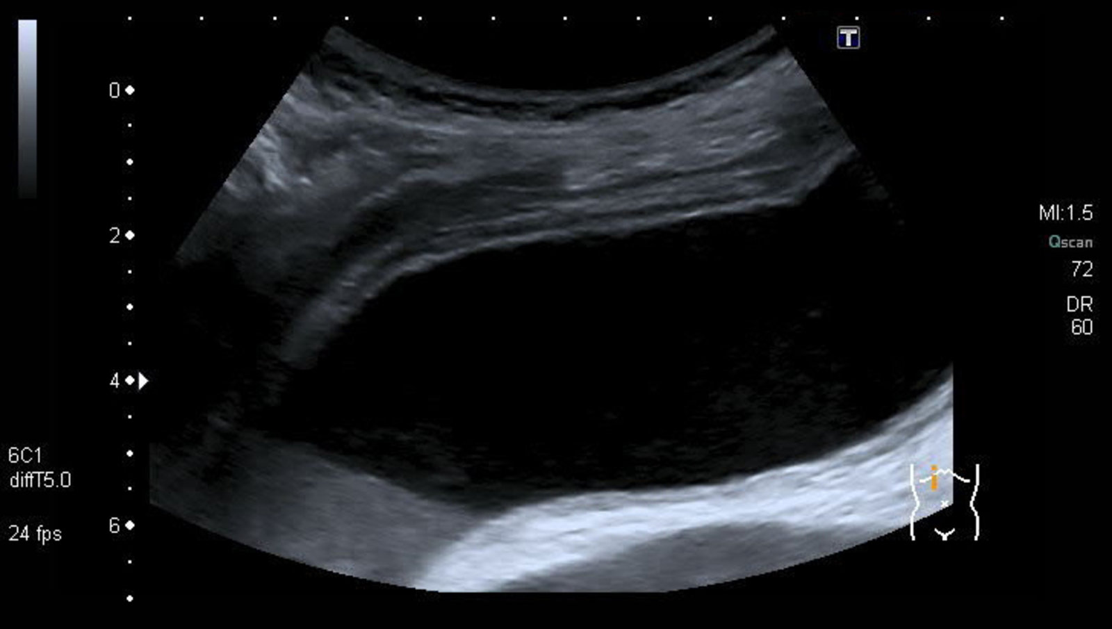 Acute acalculous cholecystitis with sludge