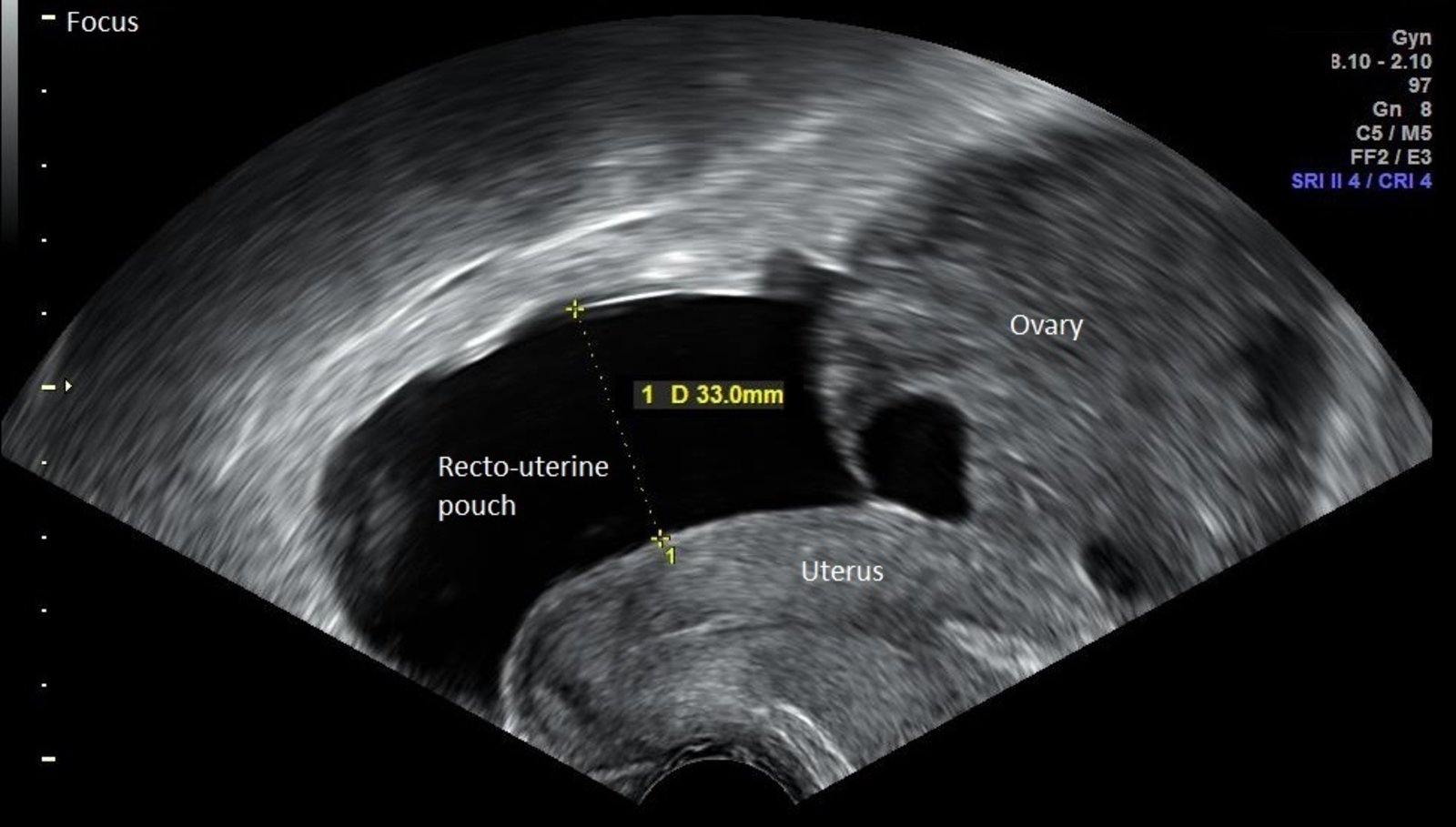 Transvaginal ultrasonography in ovarian hyperstimulation syndrome (2/2)