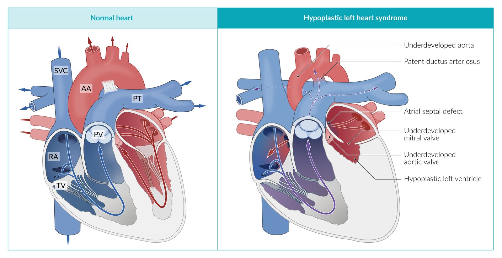 Cyanotic congenital heart defects: hypoplastic left heart syndrome