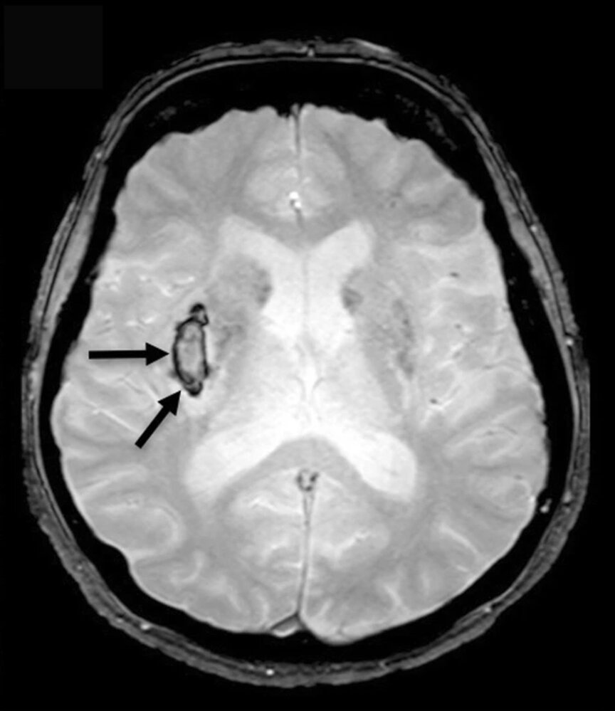 Hyperacute intracerebral hemorrhage