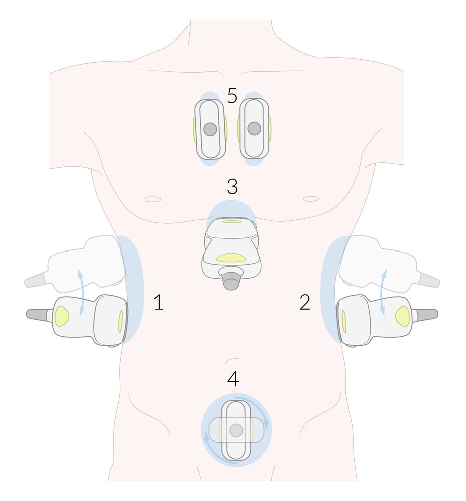 eFAST: Placement of the transducer