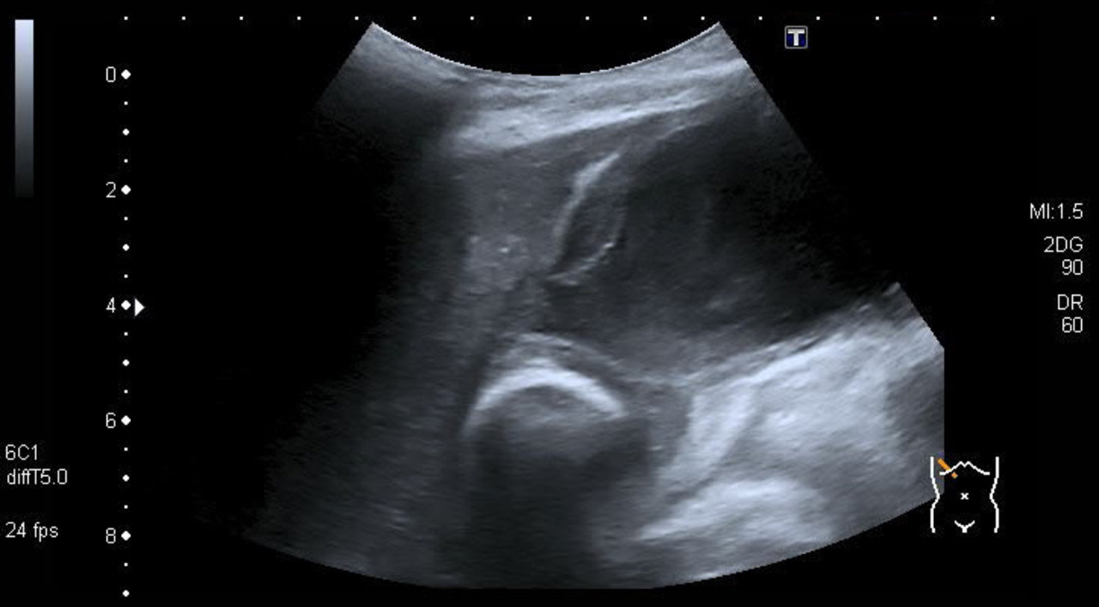 Acute calculous cholecystitis