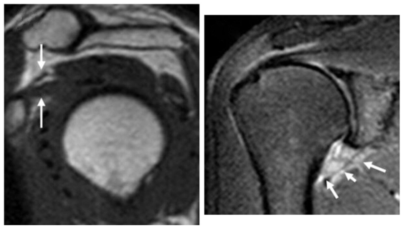 Adhesive capsulitis (frozen shoulder)