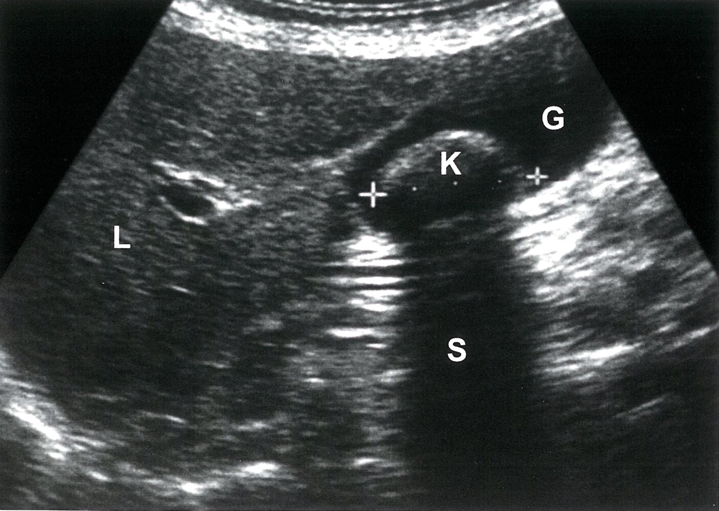 Cholelithiasis