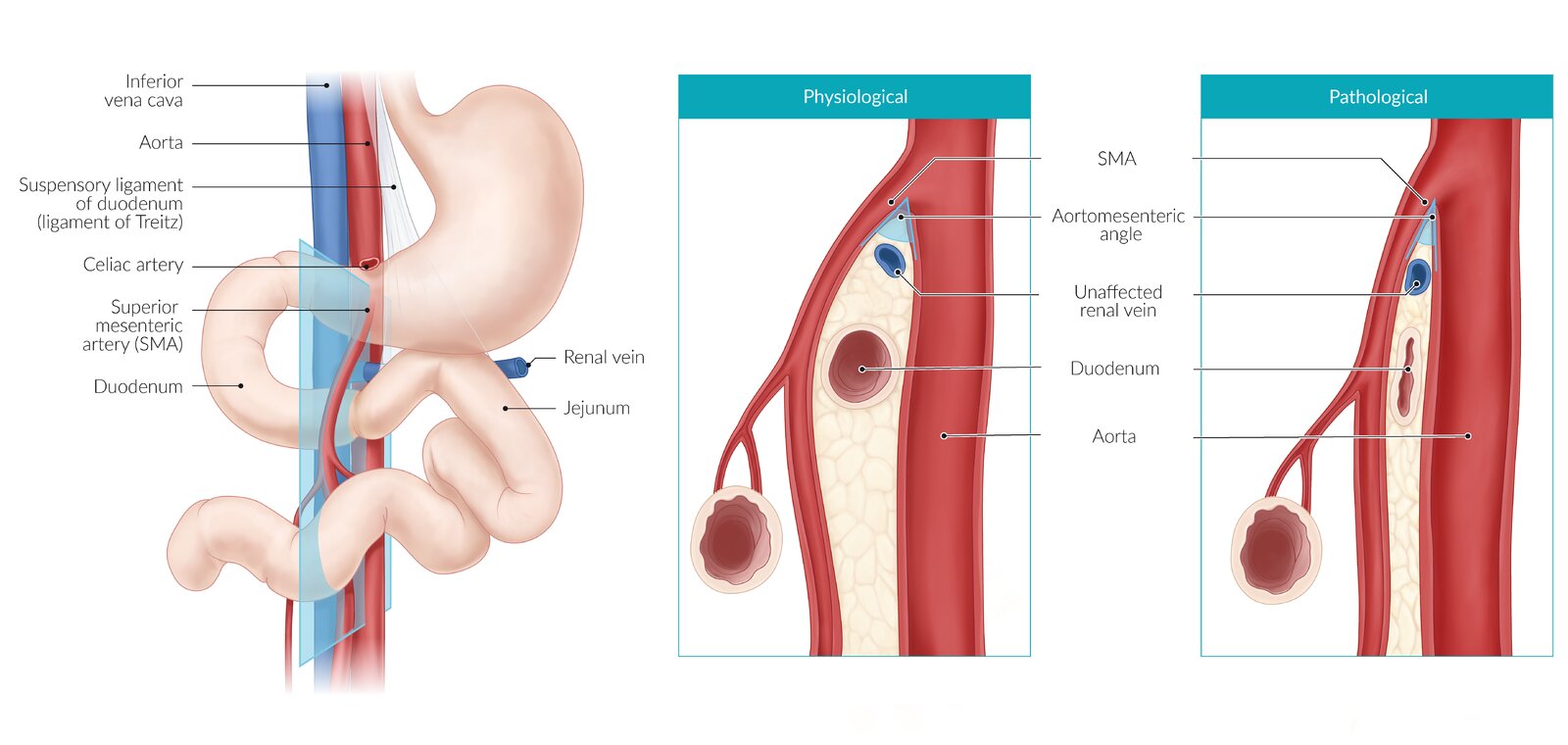 Superior mesenteric artery syndrome (SMAS)
