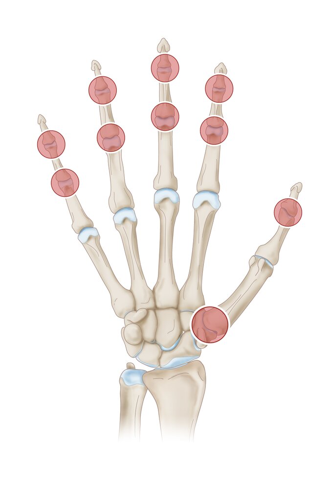 Distribution pattern of osteoarthritis of the hand