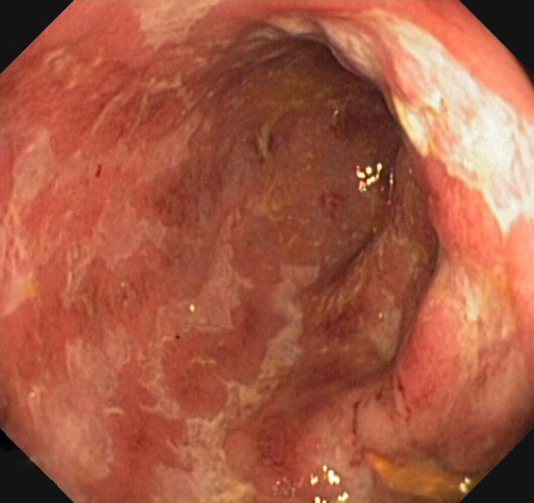 Colon in Crohn disease