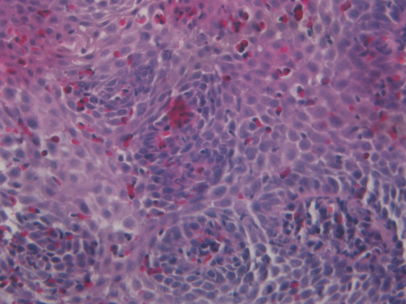 Eosinophilic esophagitis