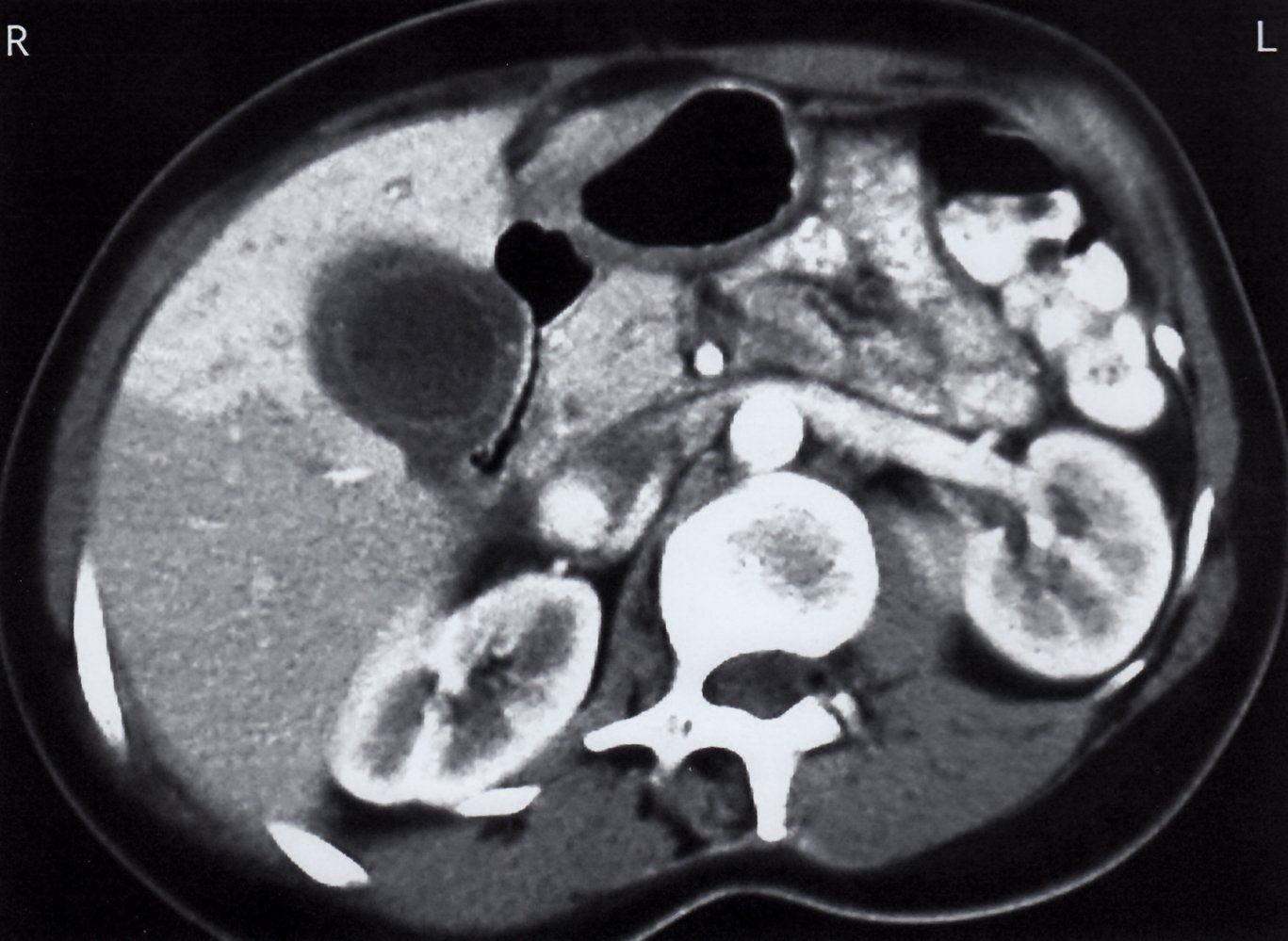 Acute cholecystitis