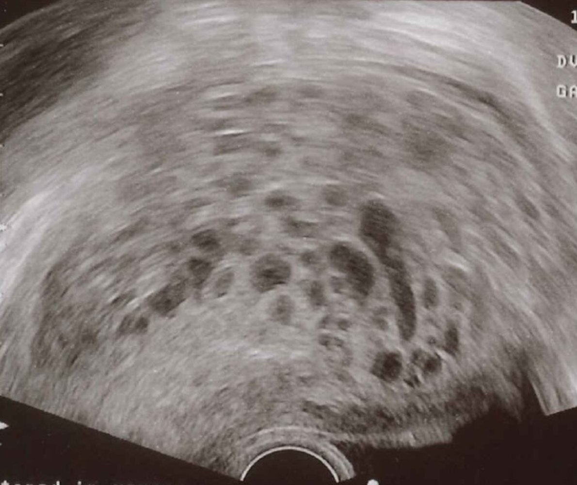 Hydatidiform mole