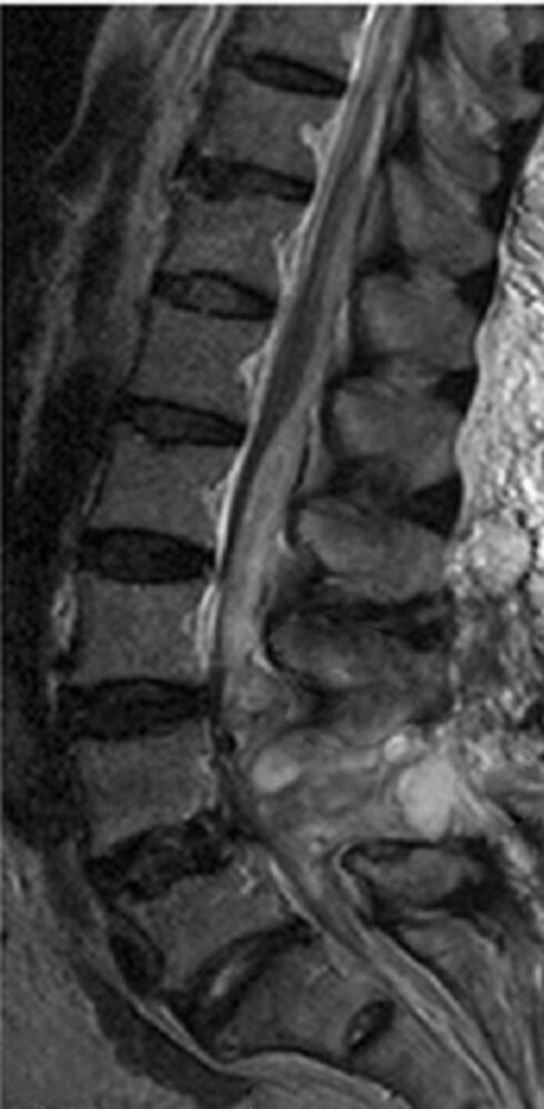 Spinal epidural hematoma