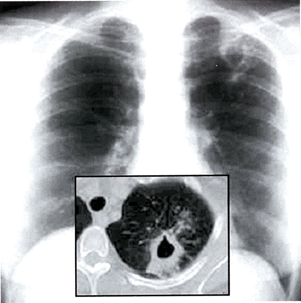 Cavitary lung lesion