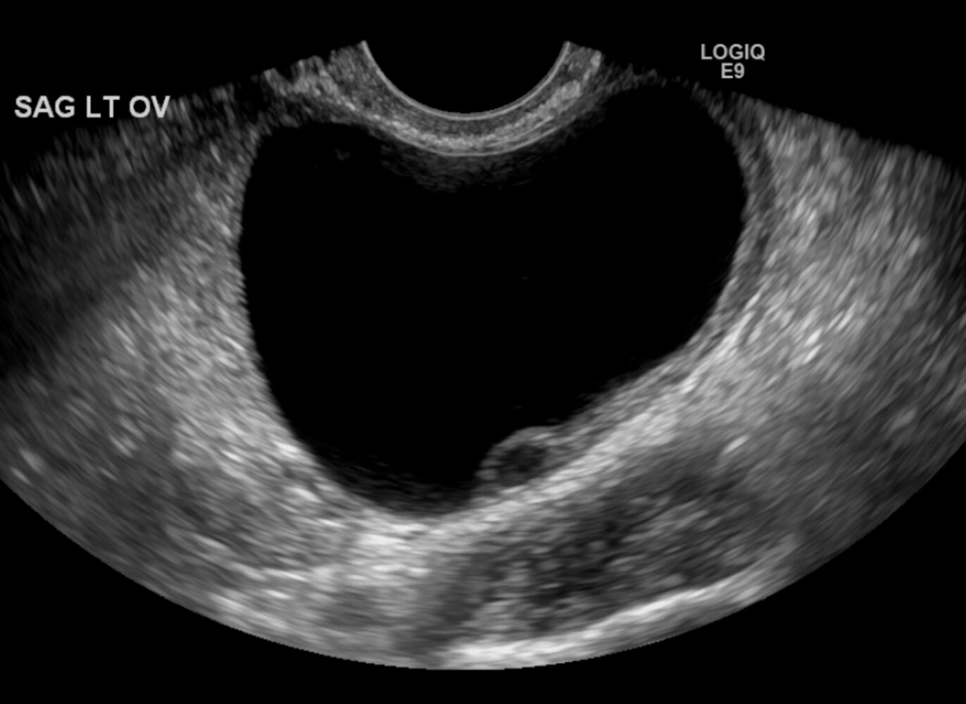Ovarian follicular cyst