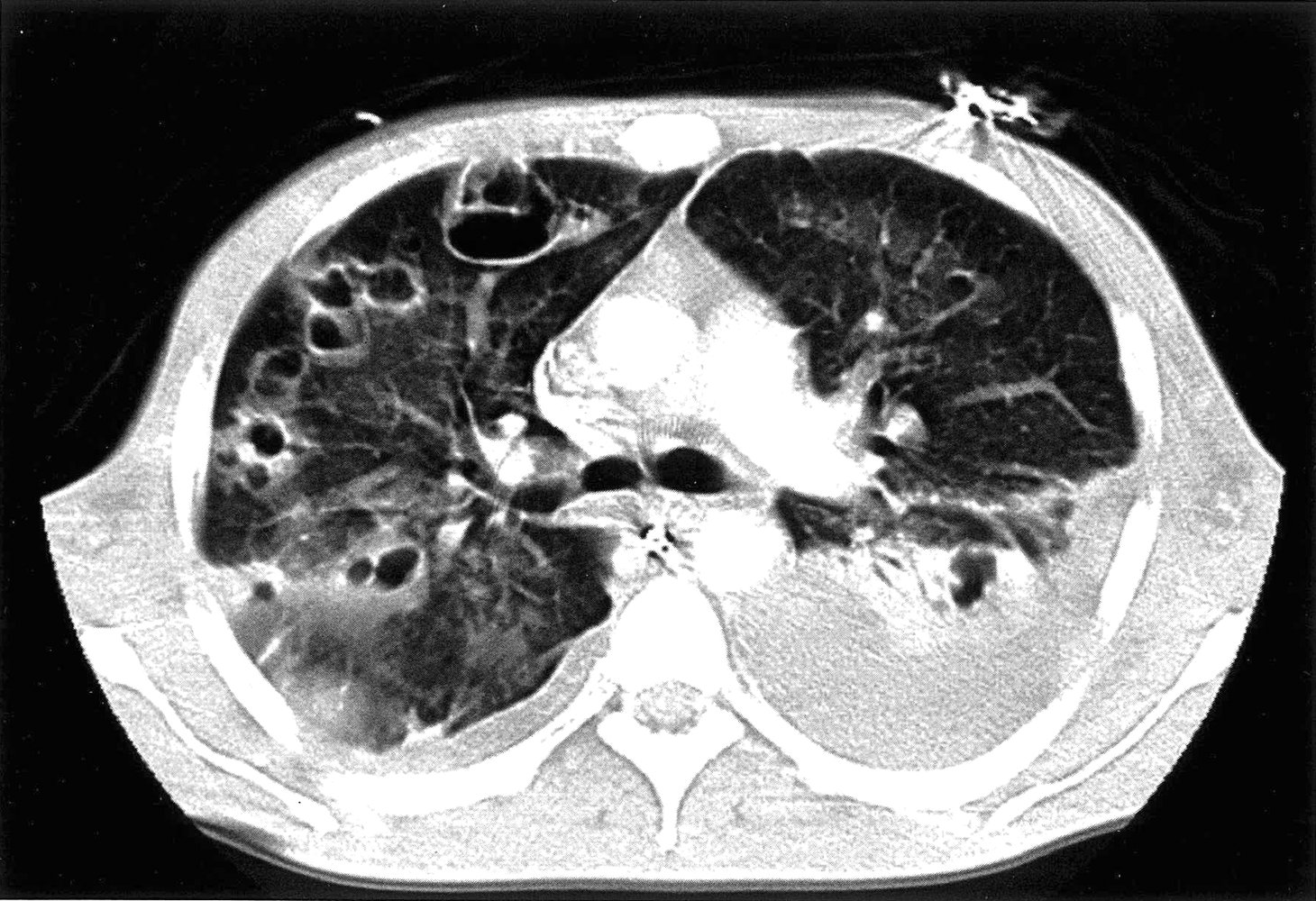 Multiple cavitary lung lesions