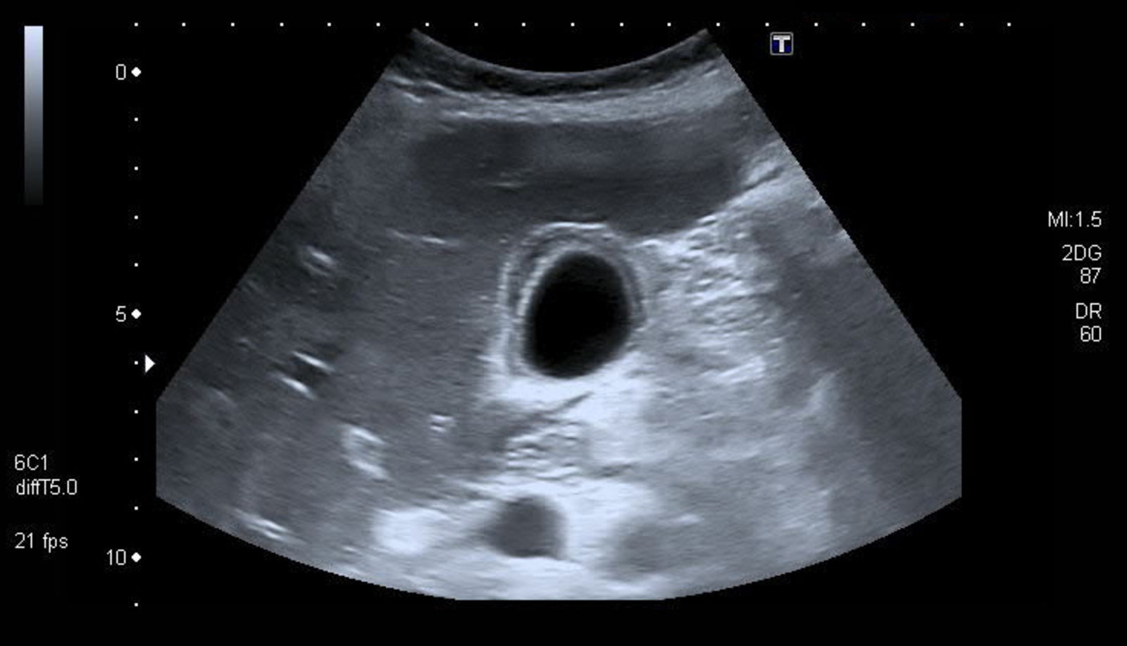 Gallbladder wall thickening