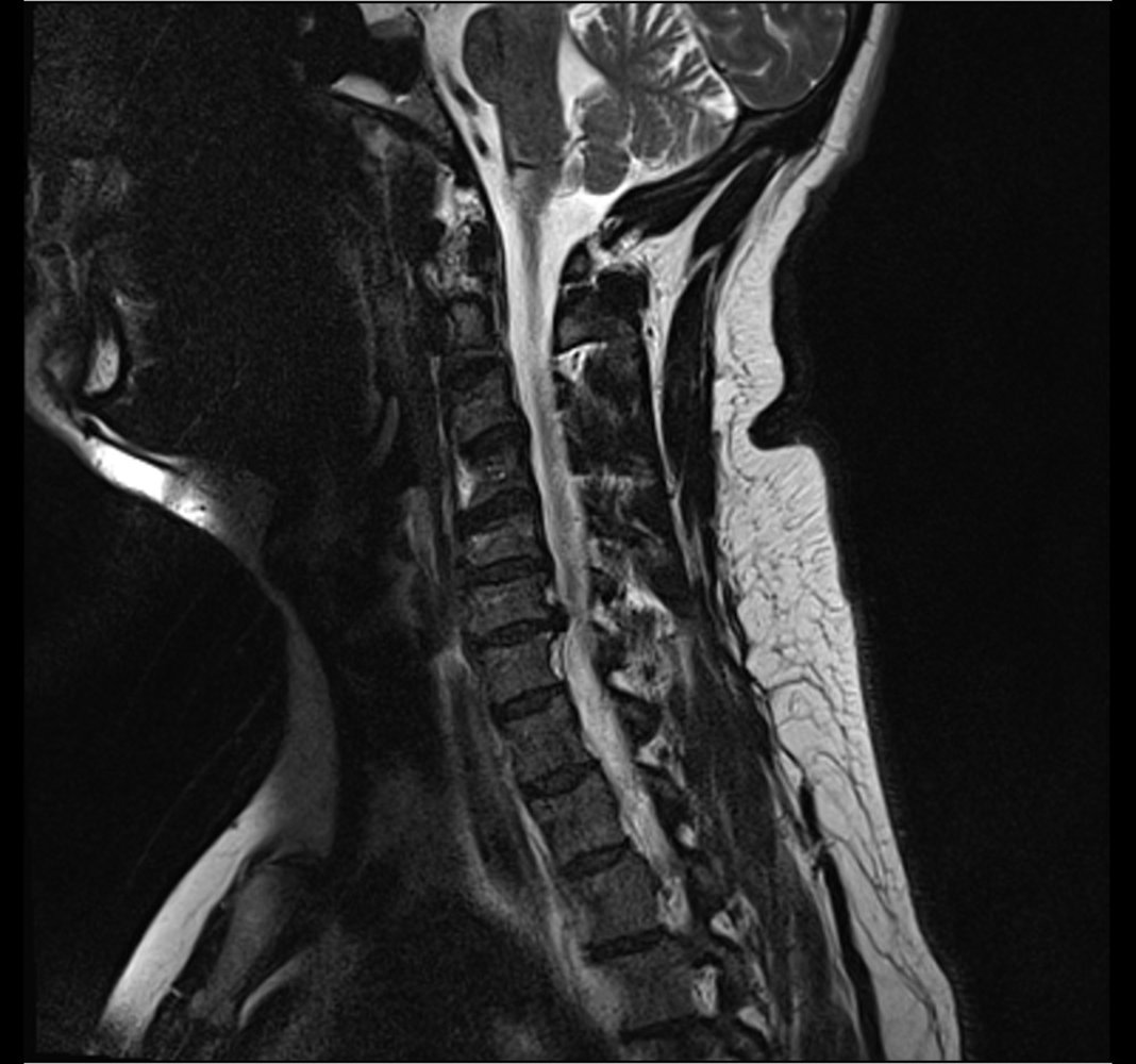 Cervical disk herniation