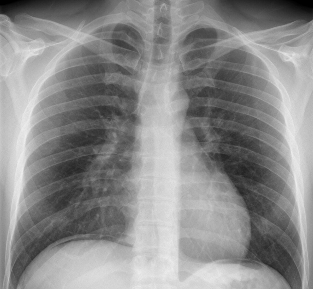 Pneumoperitoneum