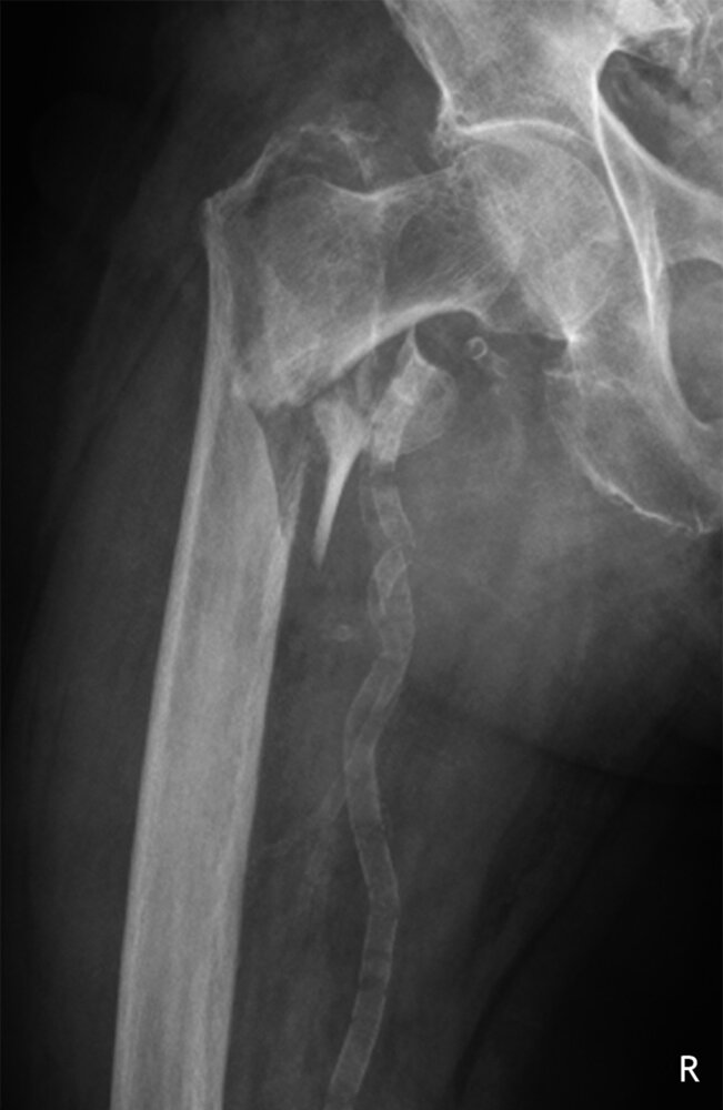 Pertrochanteric femoral fracture